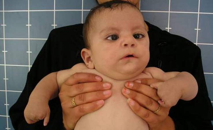 sindrome moebius neonato